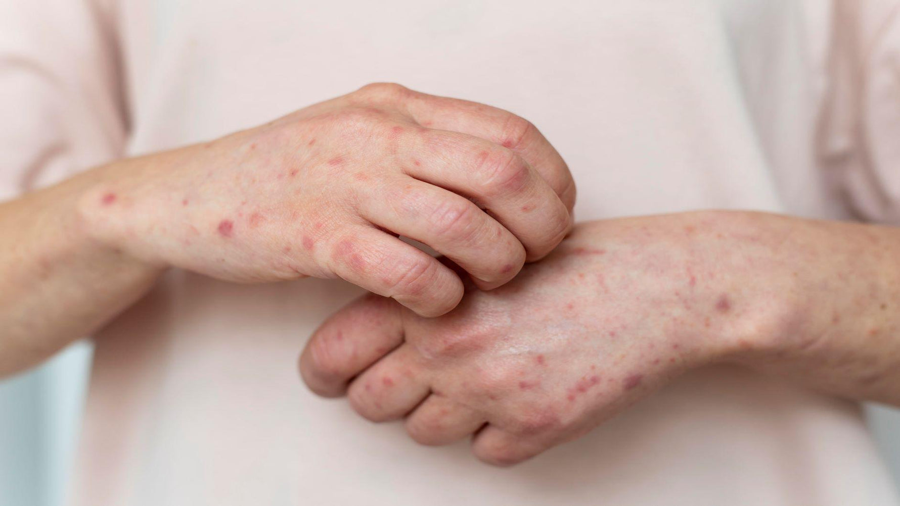 Alergias cutáneas: lo que hay que saber para tener una piel sana y feliz - Inbiotech SAS