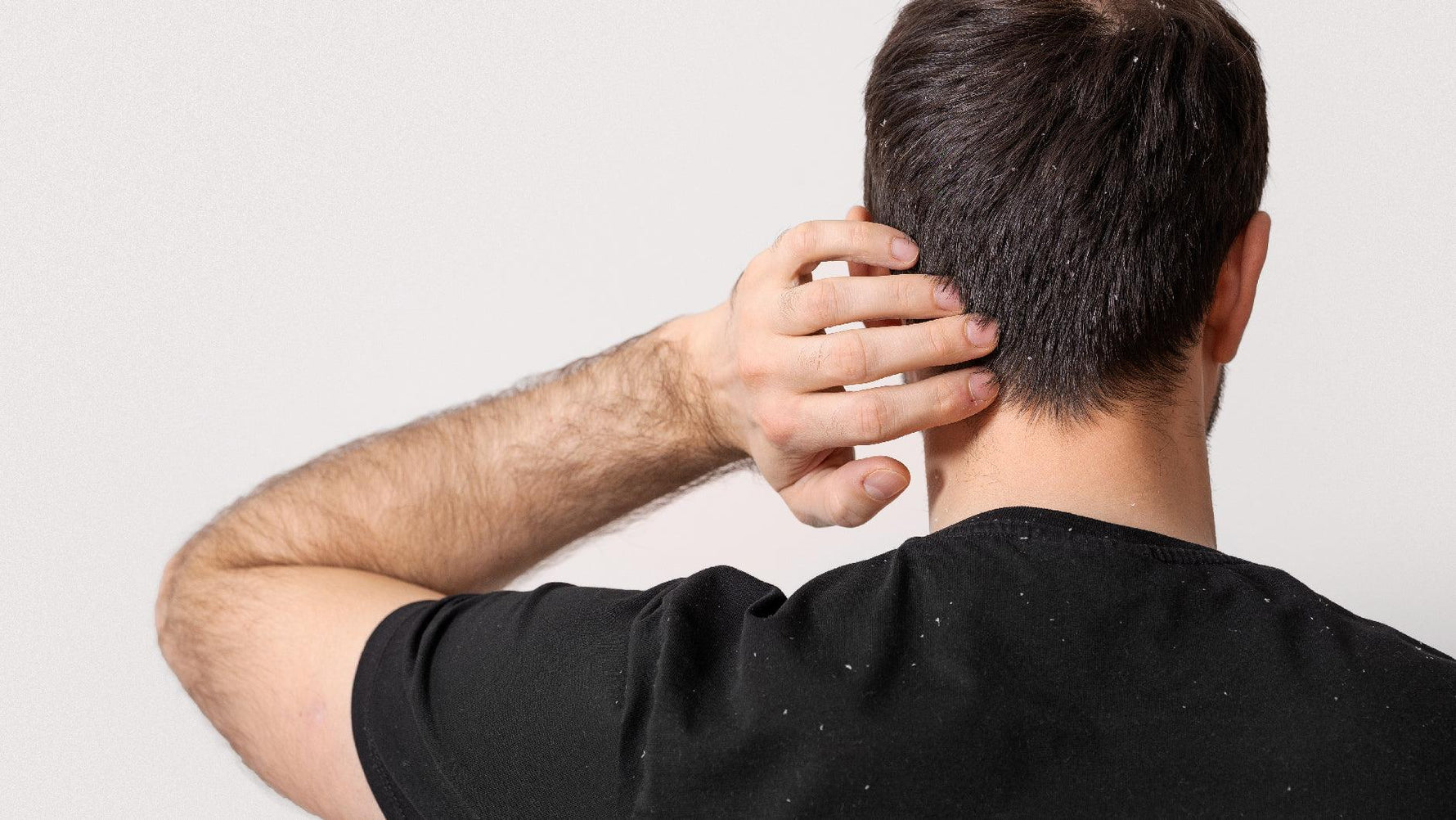 ¡Tengo caspa! ¿Cómo debo tratarla y qué la genera? - Inbiotech SAS