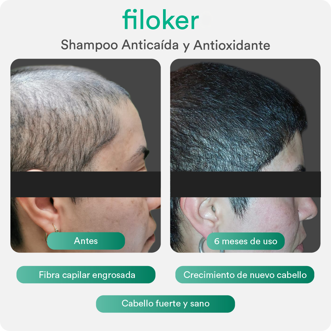 Filoker Shampoo / Caída del pelo
