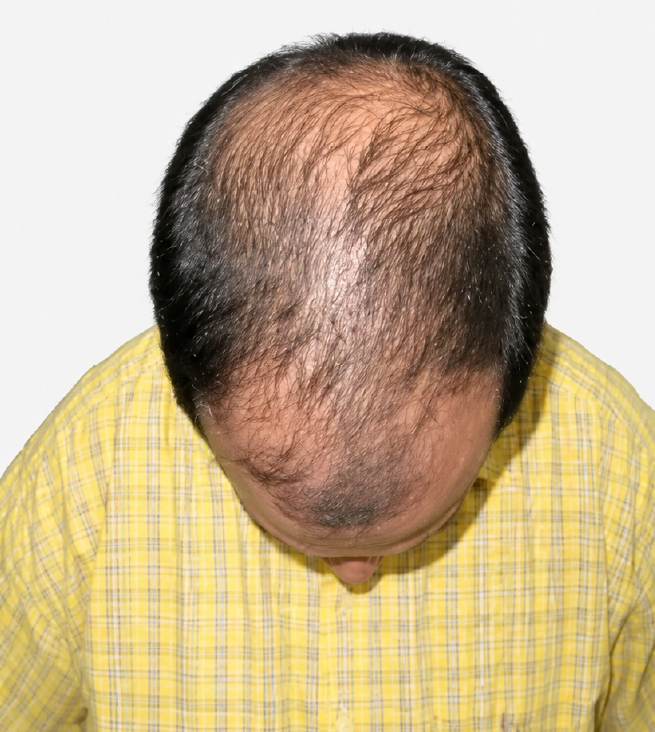 Cabello antes de usar la rutina Inbiotech