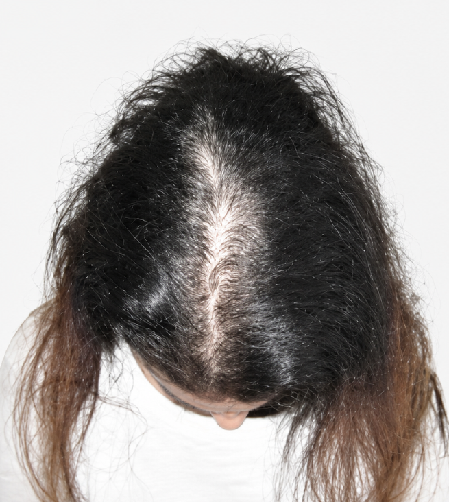Cabello antes de usar la rutina Inbiotech