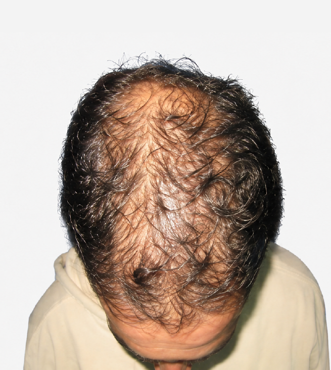 Cabello antes de usar la rutina Inbiotech