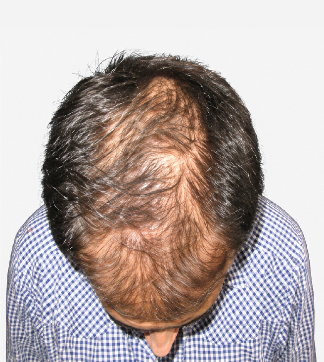 Cabello antes de usar la rutina Inbiotech