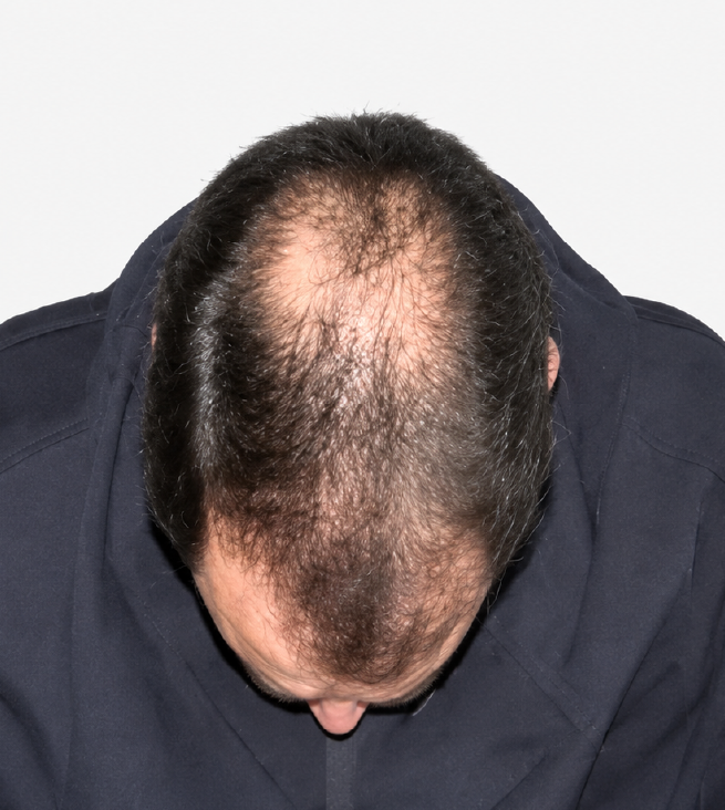 Cabello antes de usar la rutina Inbiotech