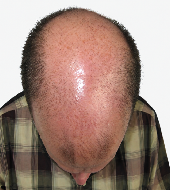 Cabello antes de usar la rutina Inbiotech