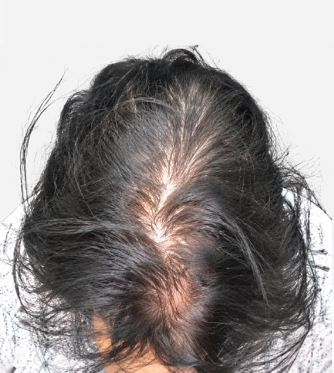 Cabello antes de usar la rutina Inbiotech