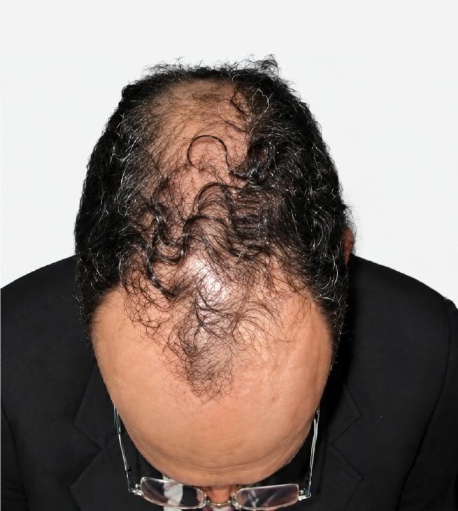 Cabello antes de usar la rutina Inbiotech