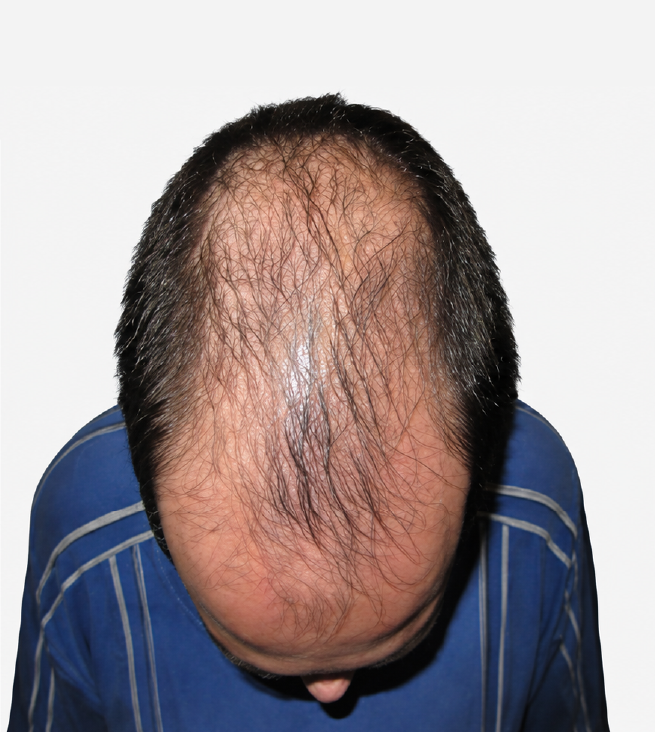Cabello antes de usar la rutina Inbiotech