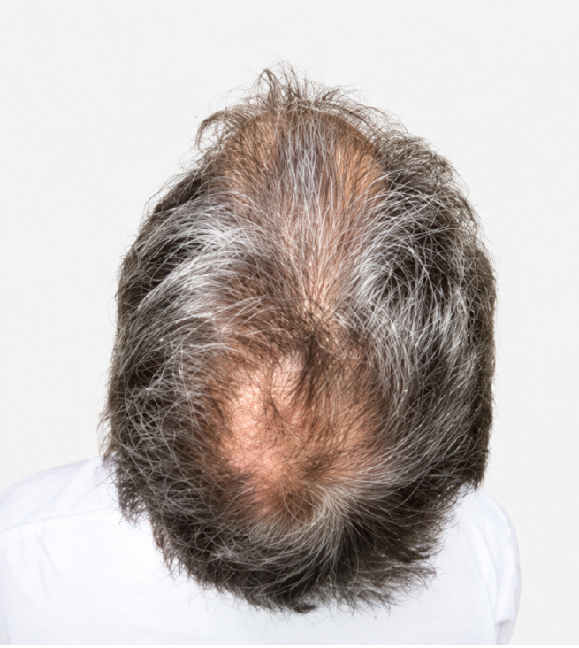 Cabello antes de usar la rutina Inbiotech