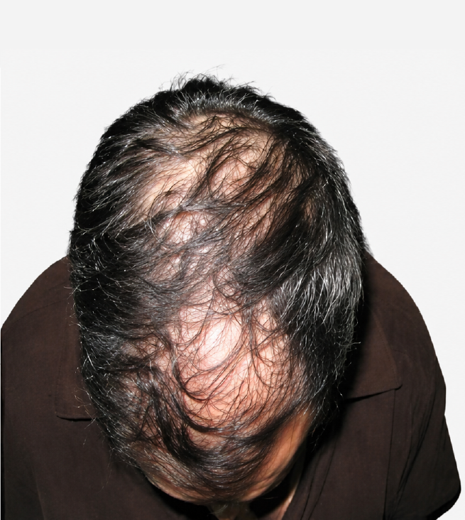 Cabello antes de usar la rutina Inbiotech