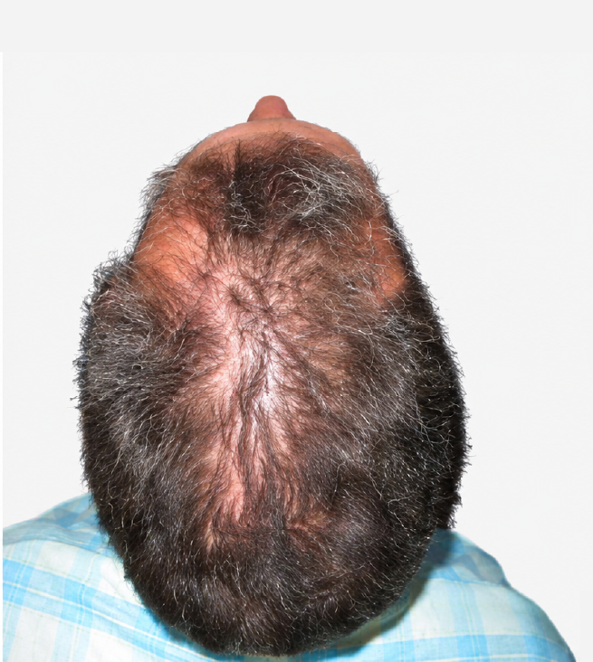 Cabello antes de usar la rutina Inbiotech