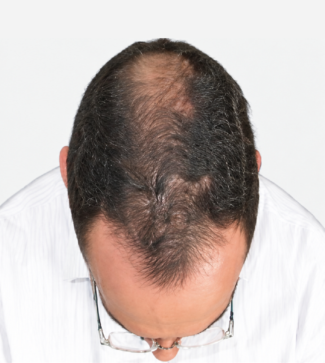 Cabello después de usar la rutina Inbiotech