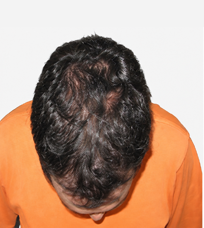 Cabello después de usar la rutina Inbiotech